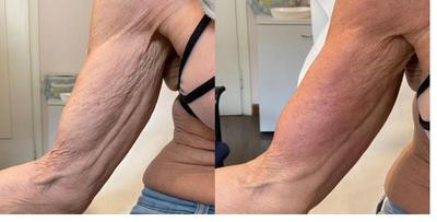 Avant/Après TeslaMed - Acné