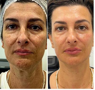 Avant/Après TeslaMed - Contour des yeux