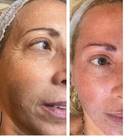 Avant/Après TeslaMed - Rajeunissement