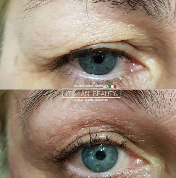 Avant/Après TeslaMed C — Contour des yeux