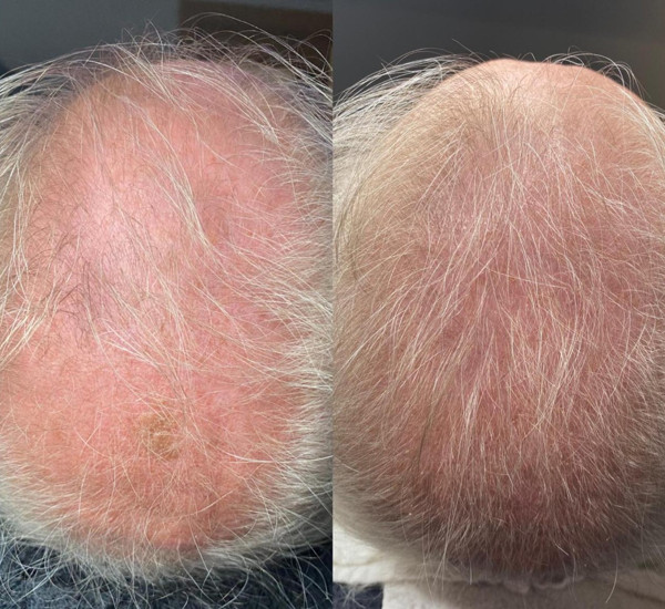 Avant/Après TeslaMed E — Scalp (cuir chevelu)