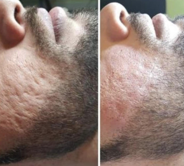 Avant/Après TeslaMed F — Resurfaçage visage