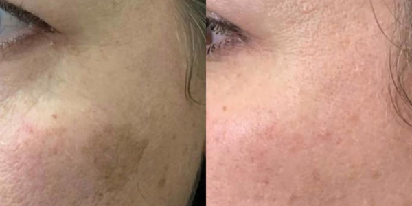Avant/Après TeslaMed G — Soin visage
