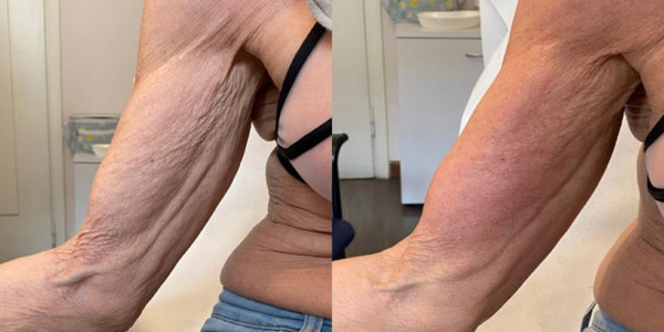Avant/Après TeslaMed H — Élasticité bras
