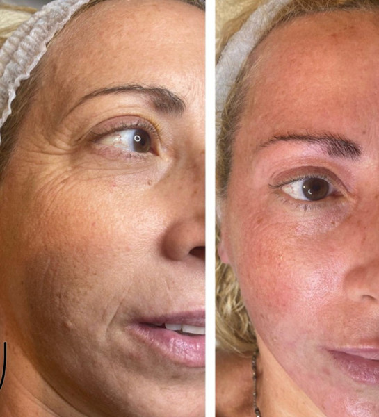 Avant/Après TeslaMed L — Soin visage