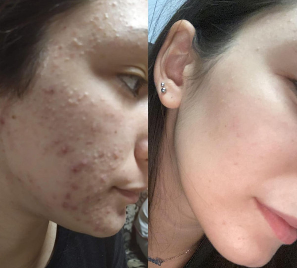 Avant/Après TeslaMed M — Acné inflammatoire
