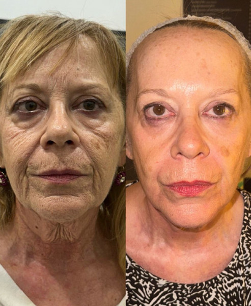Avant/Après TeslaMed N — Soin visage