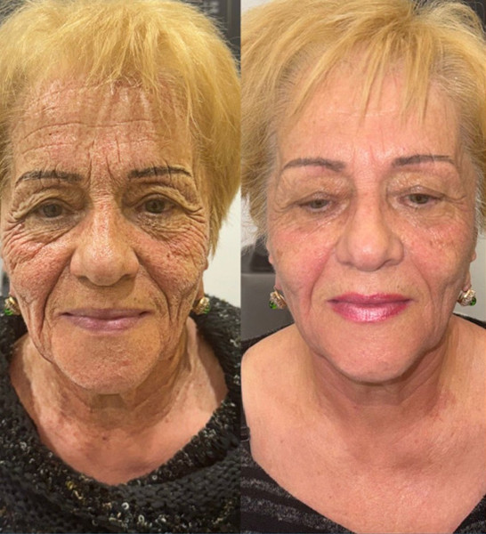Avant/Après TeslaMed O — Soin visage