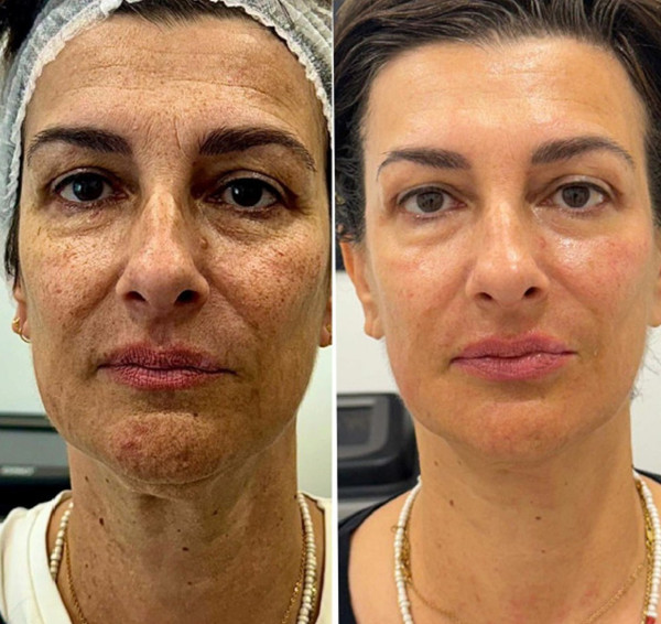 Avant/Après TeslaMed P — Soin visage